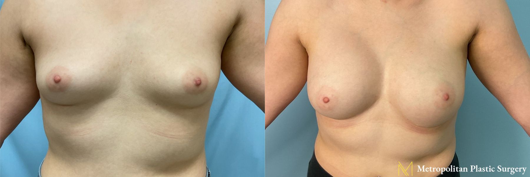 Before and after Breast Augmentation case 23852