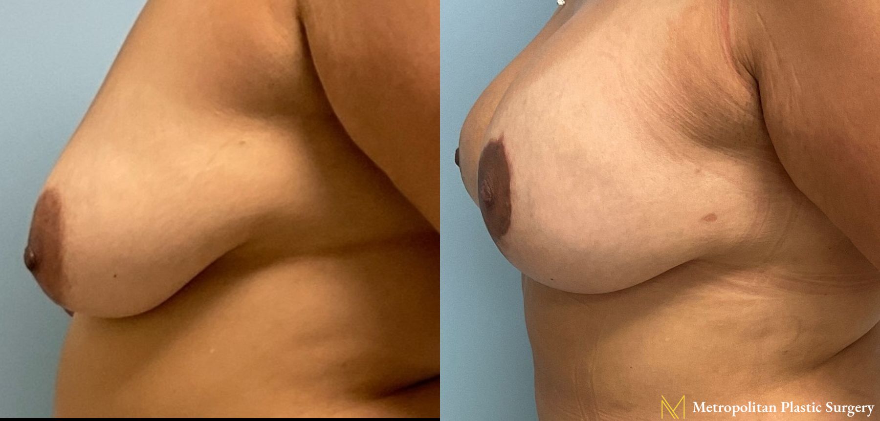 Before and after Breast Augmentation case 8061 - Angle 4