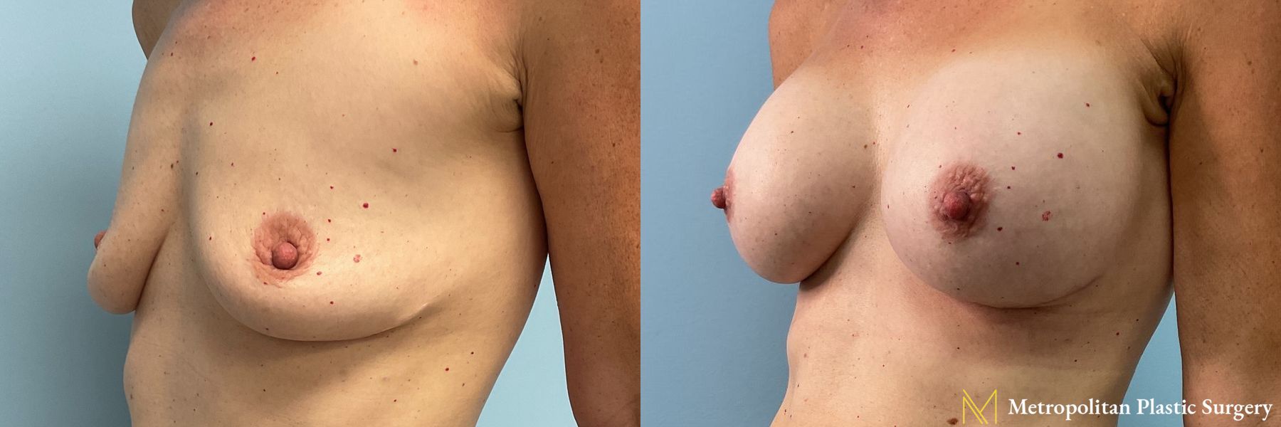 Breast Augmentation (Mammoplasty) by Julia Spears MD Before and After - Angle 2