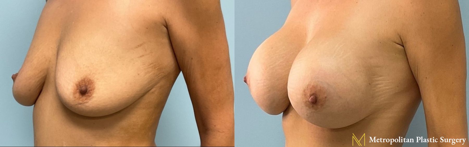 Before and after Breast Augmentation case 8102 - Angle 3