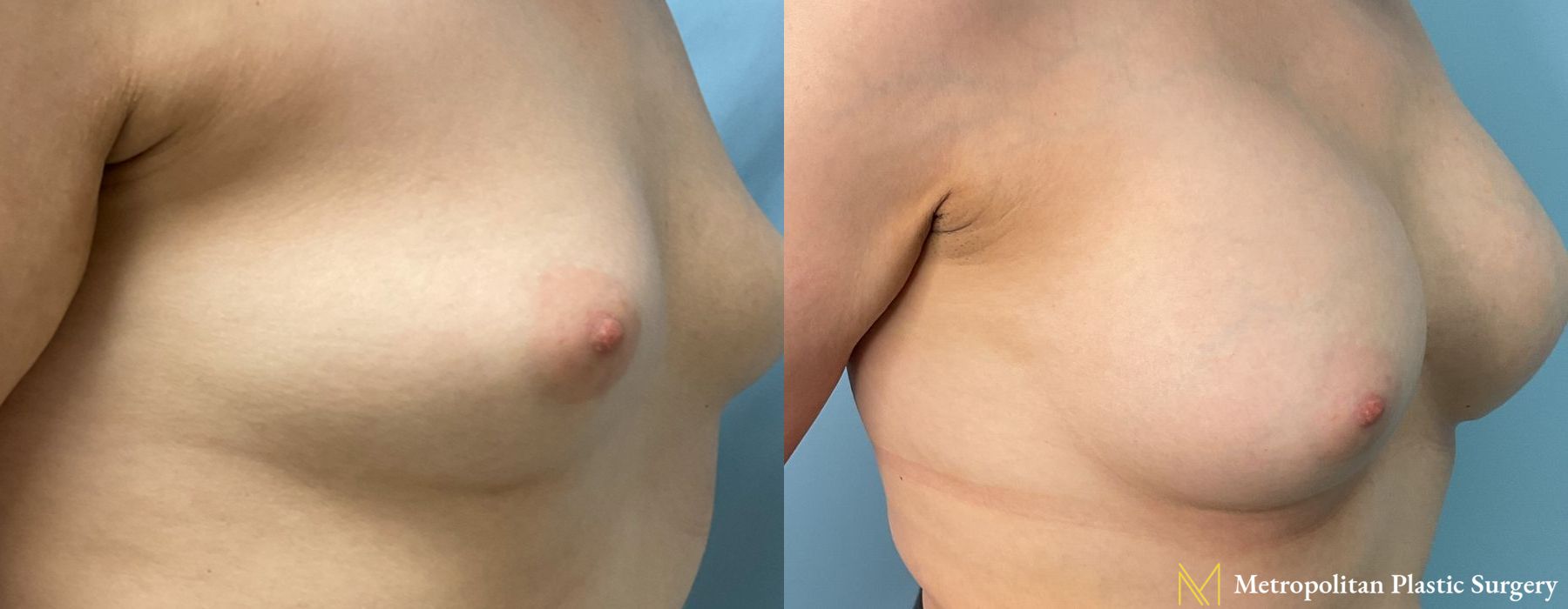 Before and after Breast Augmentation case 23852 - Angle 2