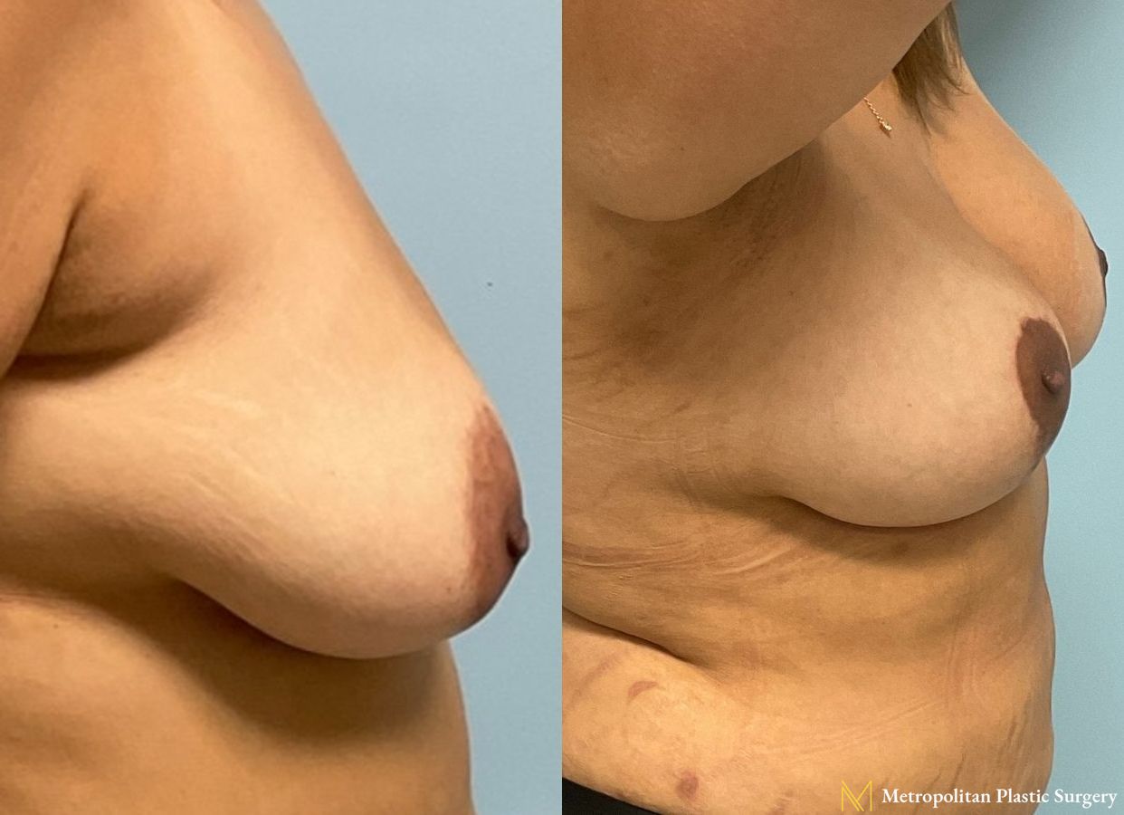 Before and after Breast Augmentation case 8061 - Angle 2