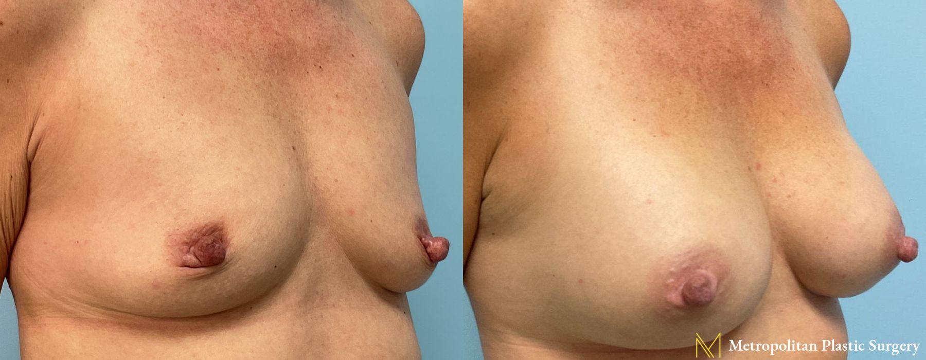 Breast Augmentation - Thumbnail 2
