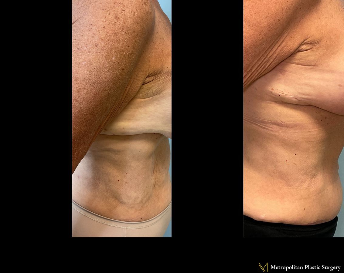 Before and after Tummy Tuck case 23903 - Angle 2