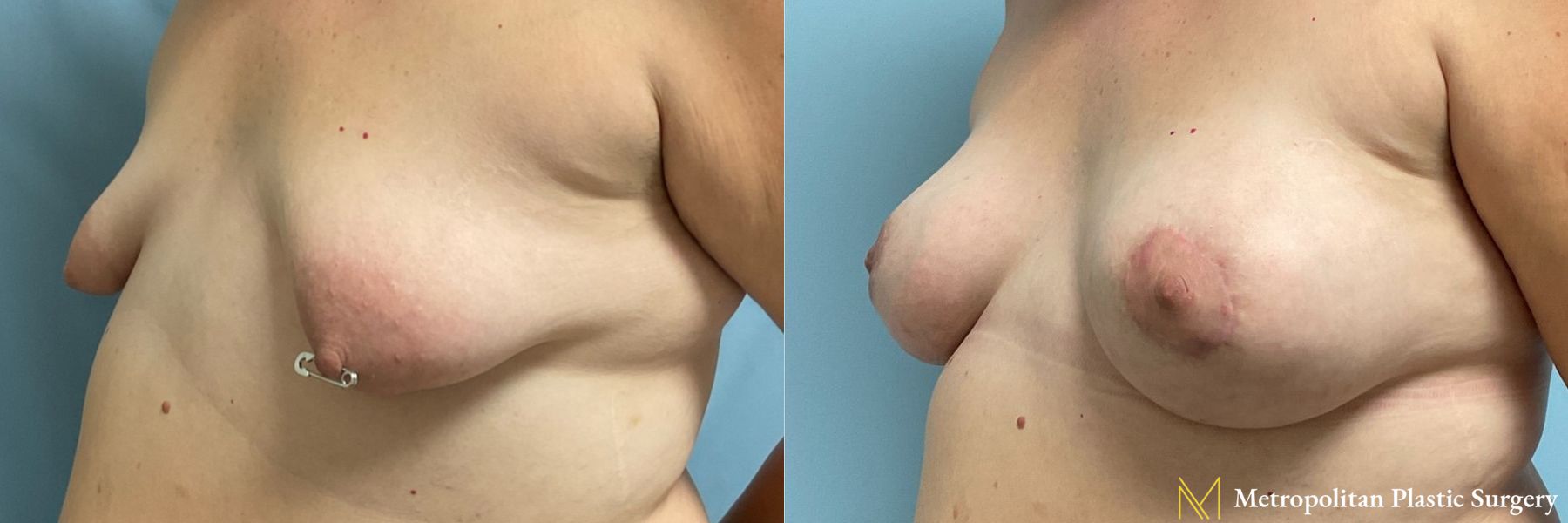 Breast Augmentation (Mammoplasty) by Julia Spears MD Before and After - Angle 5
