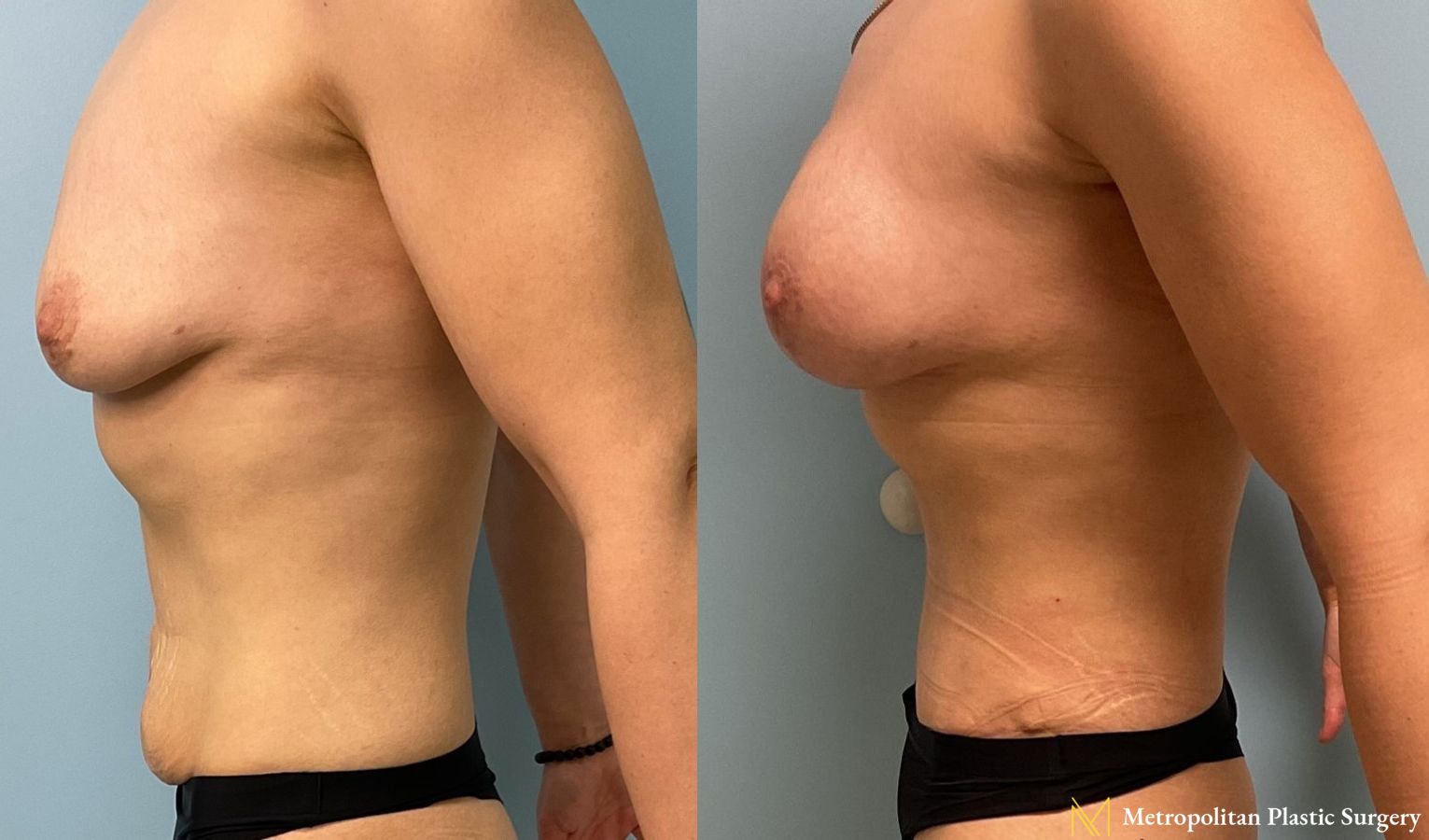 Abdominoplasty to remove excess fat, skin and tighten muscles. - Angle 2