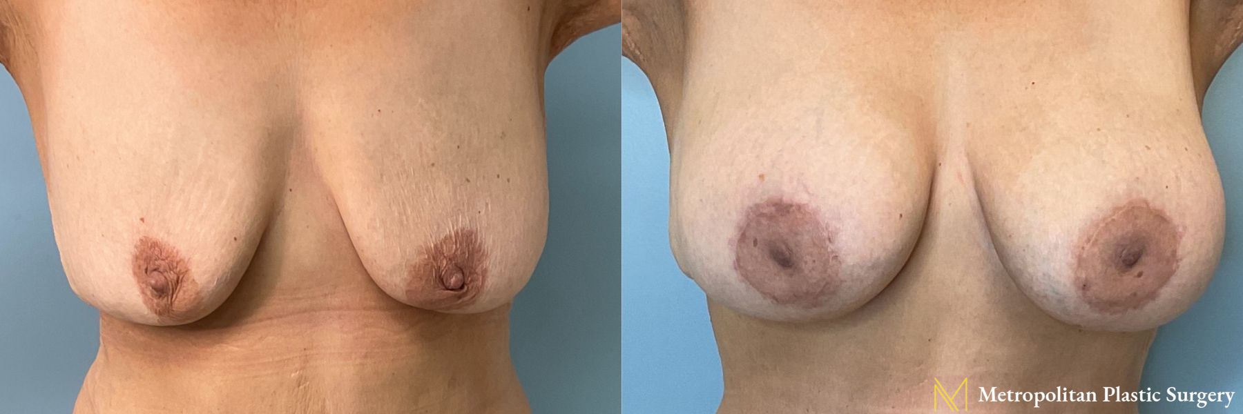 Before and after breast augmentation with breast lift