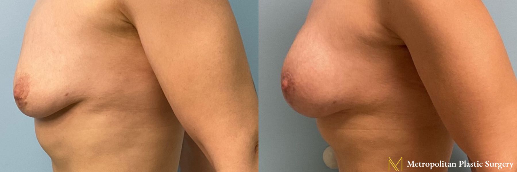 Breast Augmentation with Lift performed by Dr. Julia Spears - Angle 2