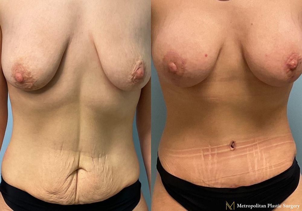 Before and after Breast Lift case 11889