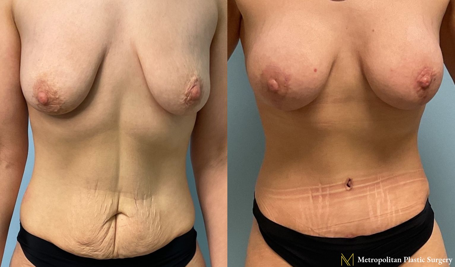 Abdominoplasty to remove excess fat, skin and tighten muscles.