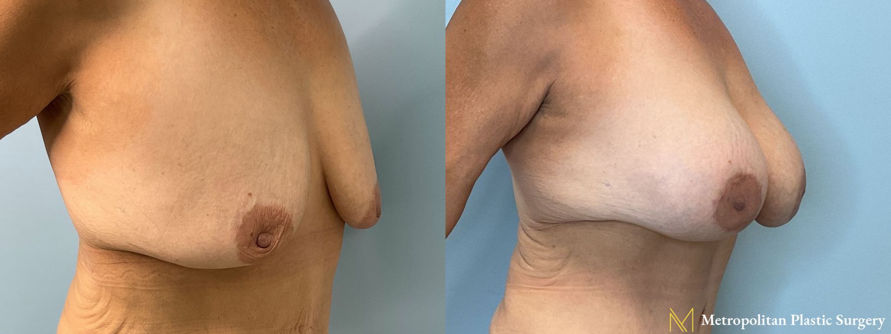 Before and after breast augmentation with breast lift - Angle 3