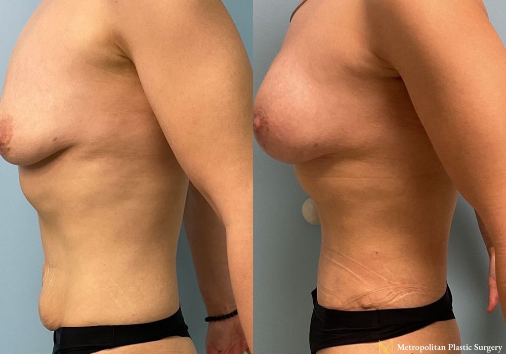 Abdominoplasty - Thumbnail 2