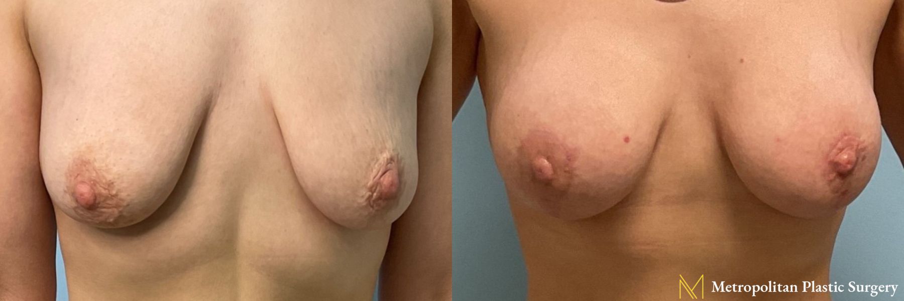 Breast Augmentation with Lift performed by Dr. Julia Spears