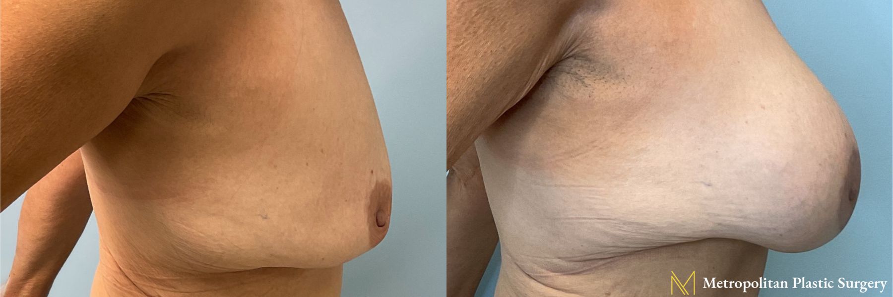 Before and after breast augmentation with breast lift - Angle 2