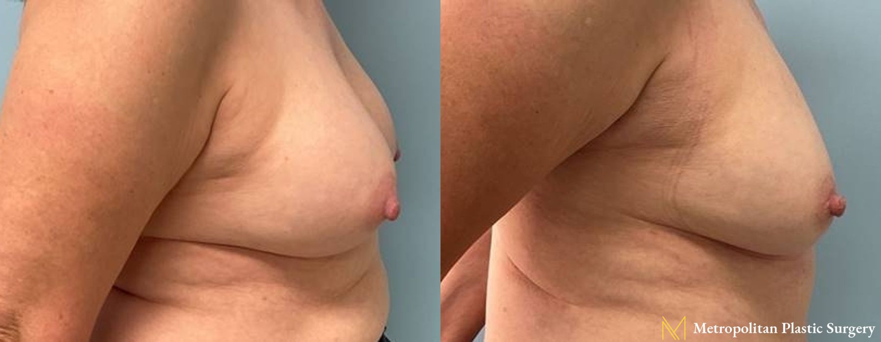 Before and after Fat Grafting case 8096 - Angle 4
