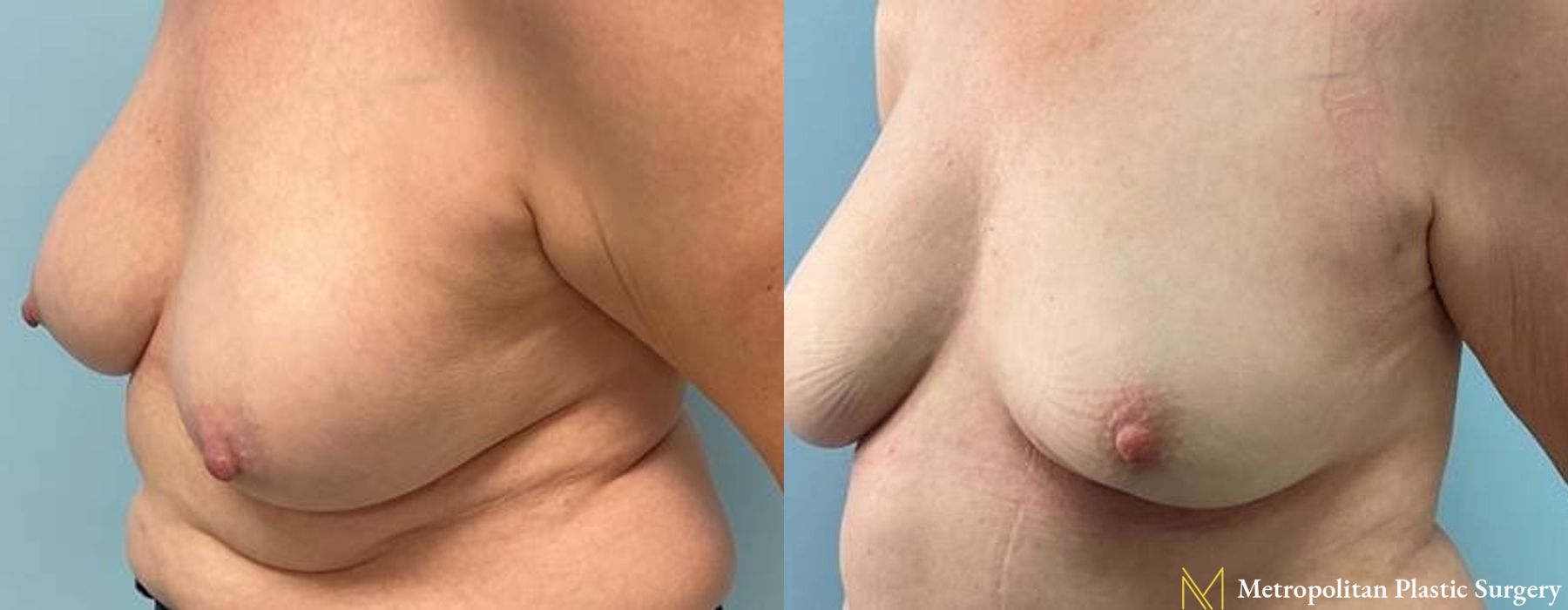 Breast Implant Removal - Thumbnail 3