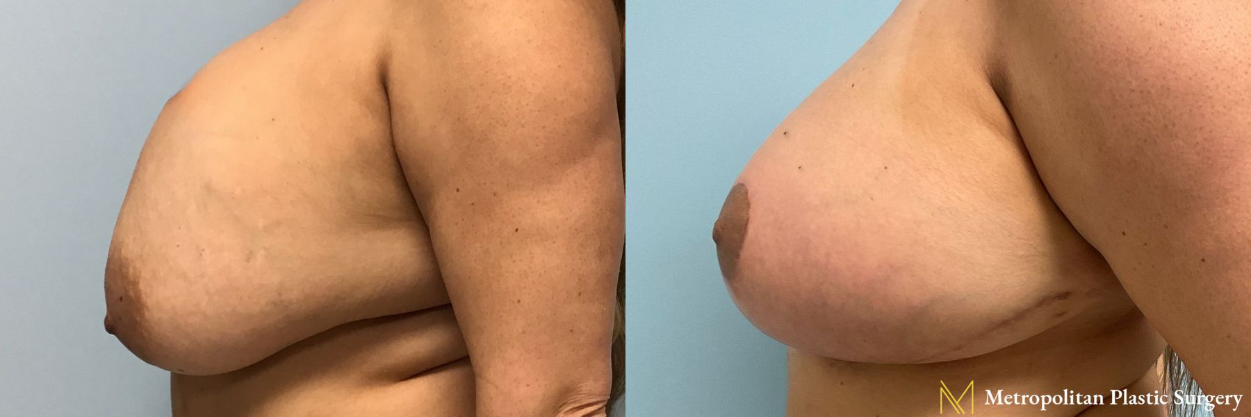 Before and after breast implant removal, breast lift and liposuction of bra rolls - Angle 3