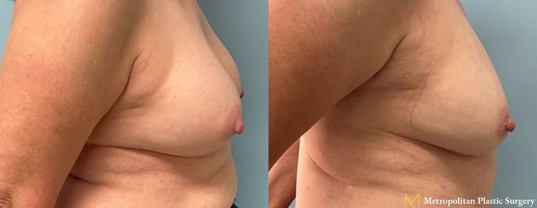 Breast Implant Removal - Thumbnail 2