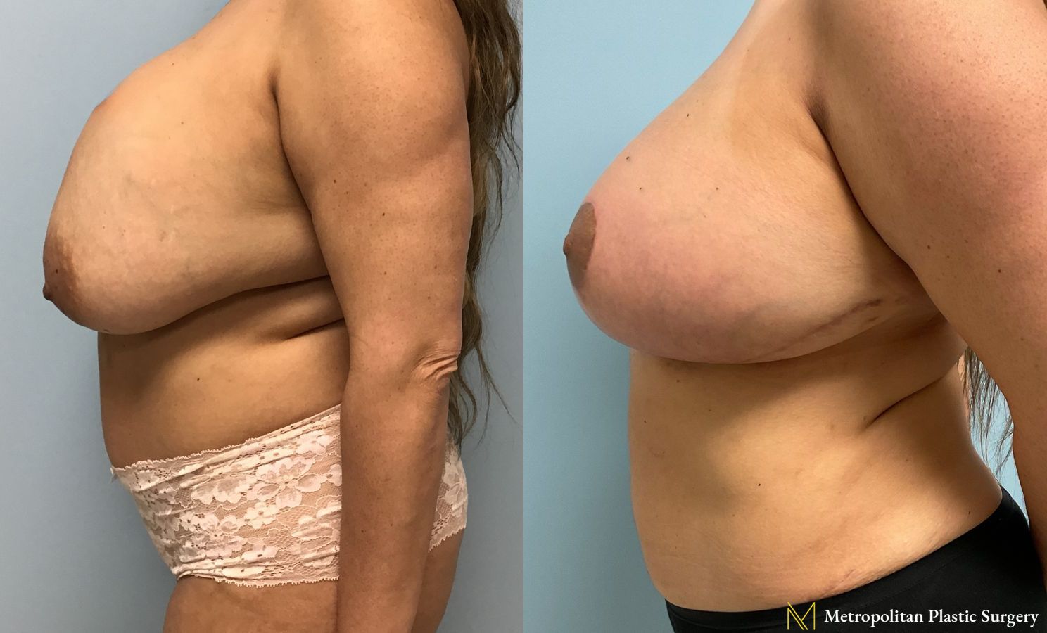 Before and after Liposuction case 24003 - Angle 3