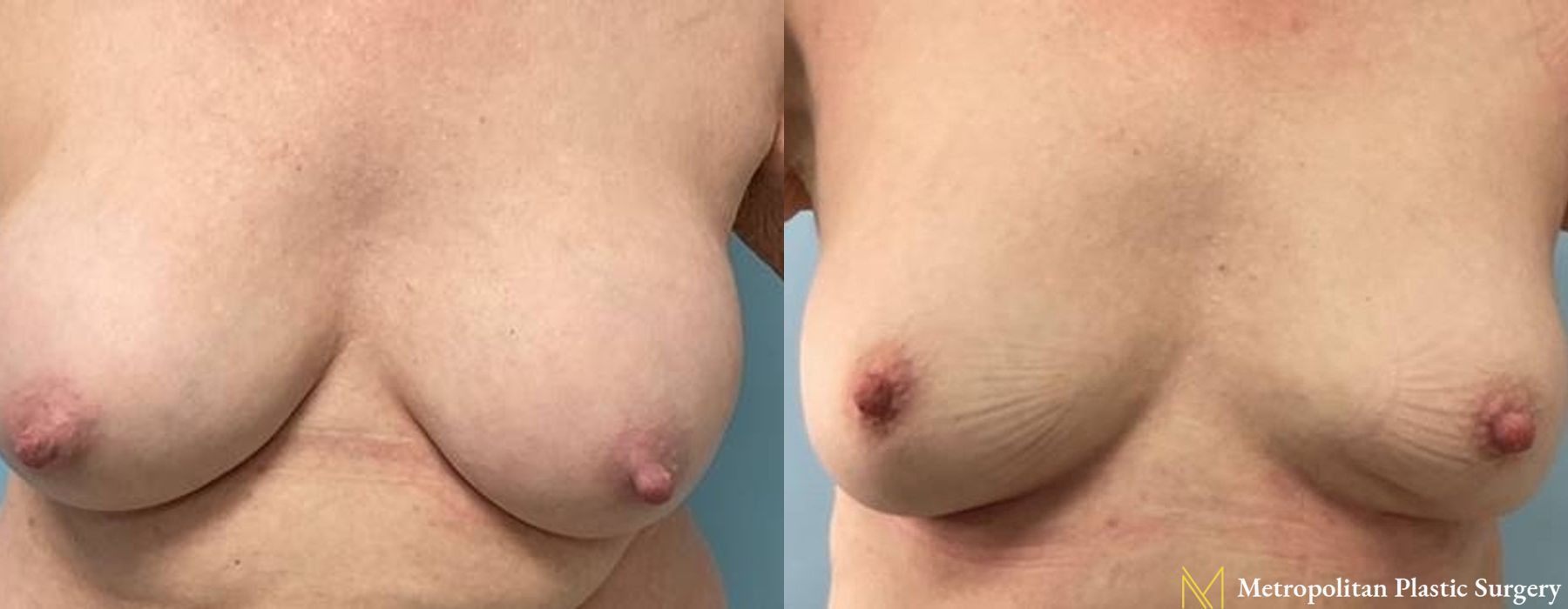 Breast Implant Removal - Thumbnail 4