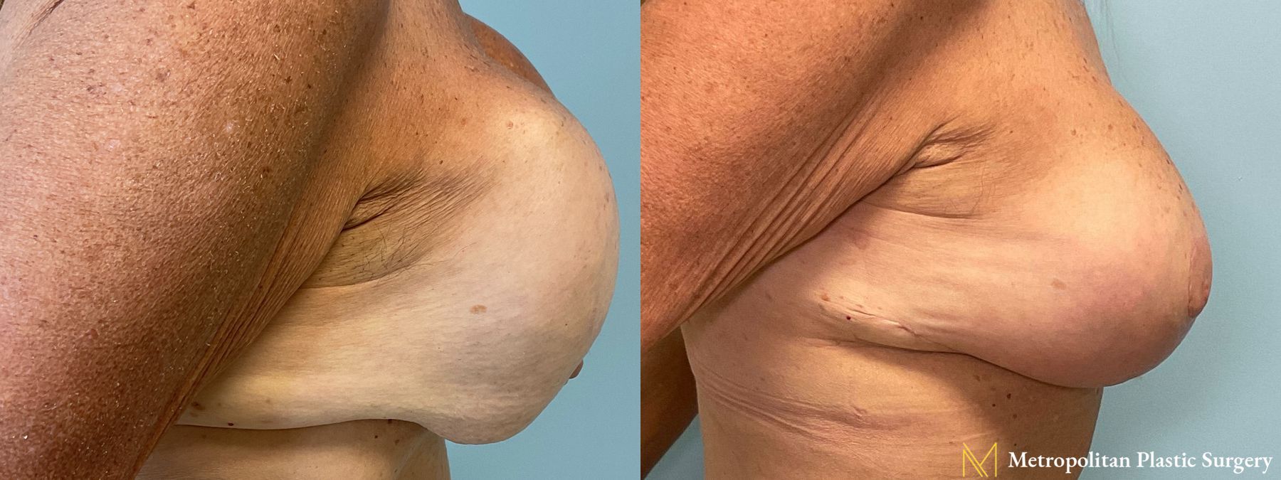 Before and after Breast Revision case 23903 - Angle 2