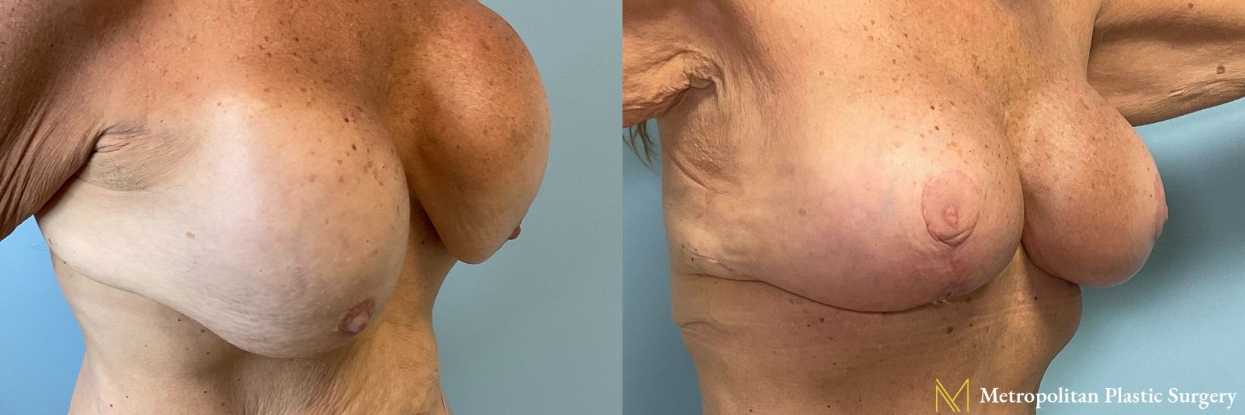 Before and after Breast Revision case 23903 - Angle 3