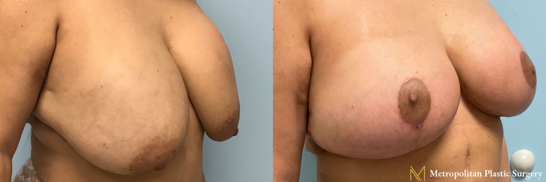 Before and after breast implant removal, breast lift and liposuction of bra rolls - Angle 2