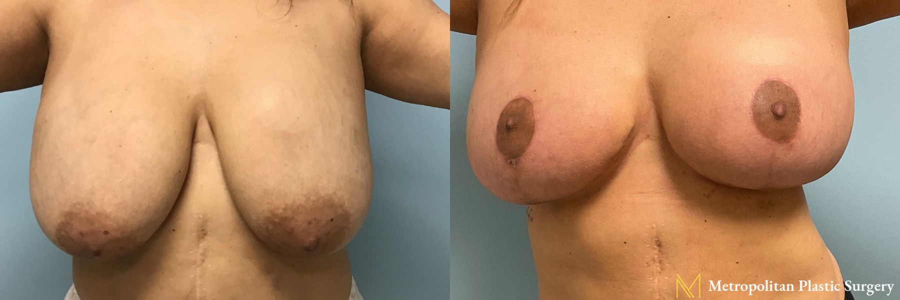 Before and after breast implant removal, breast lift and liposuction of bra rolls