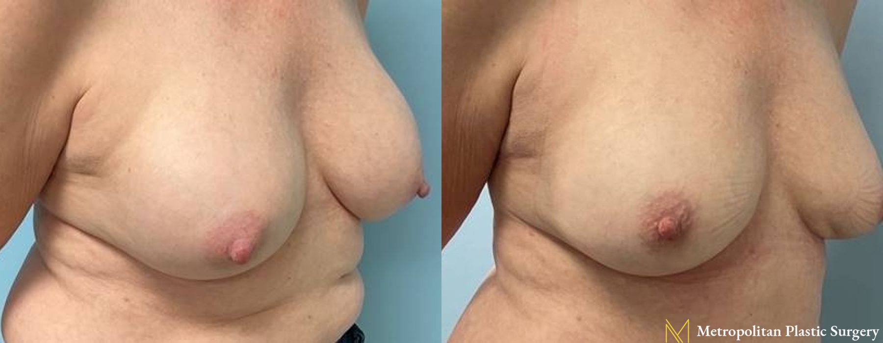 Breast Implant Removal - Thumbnail 5