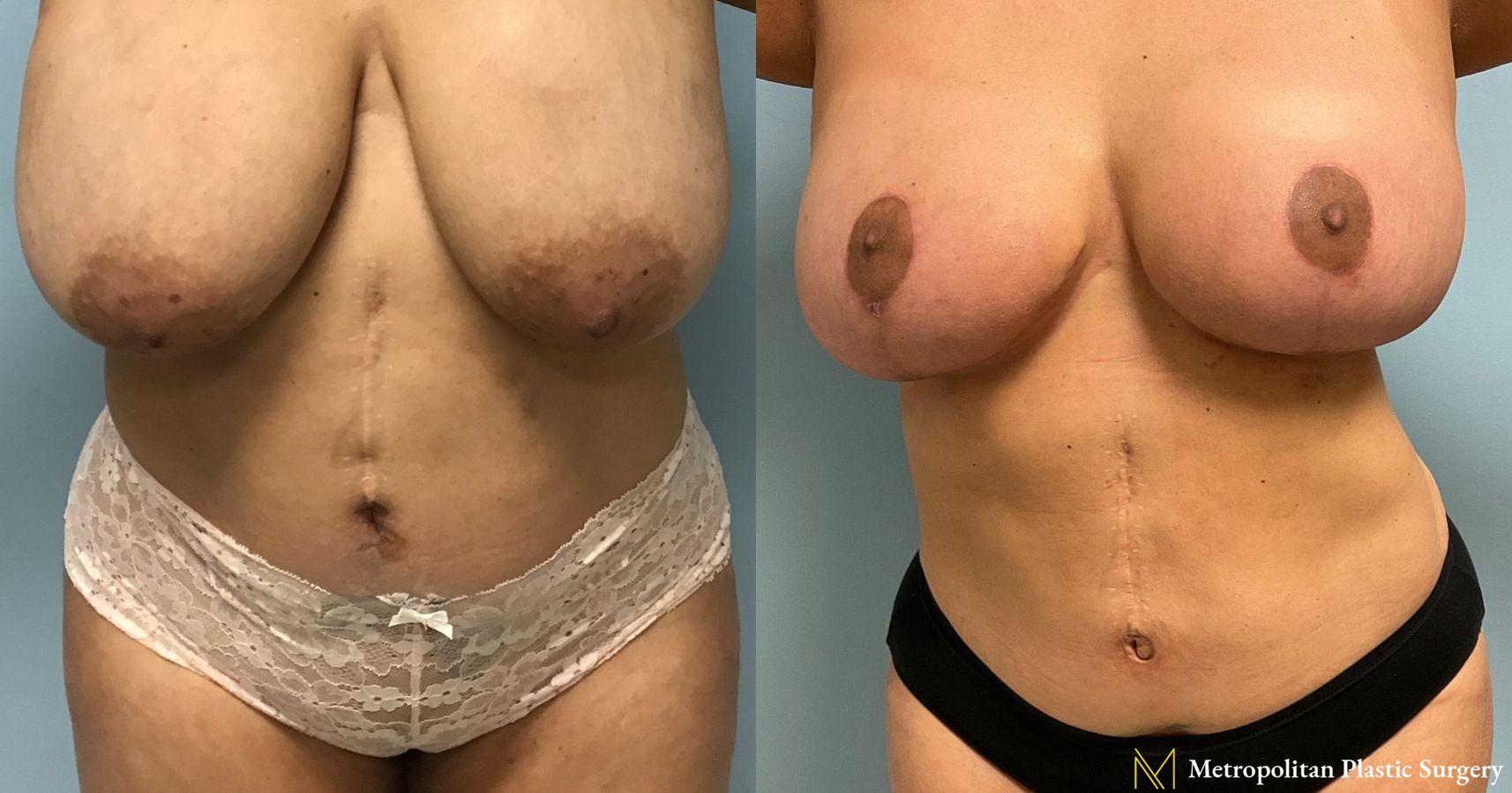 Before and after Liposuction case 24003