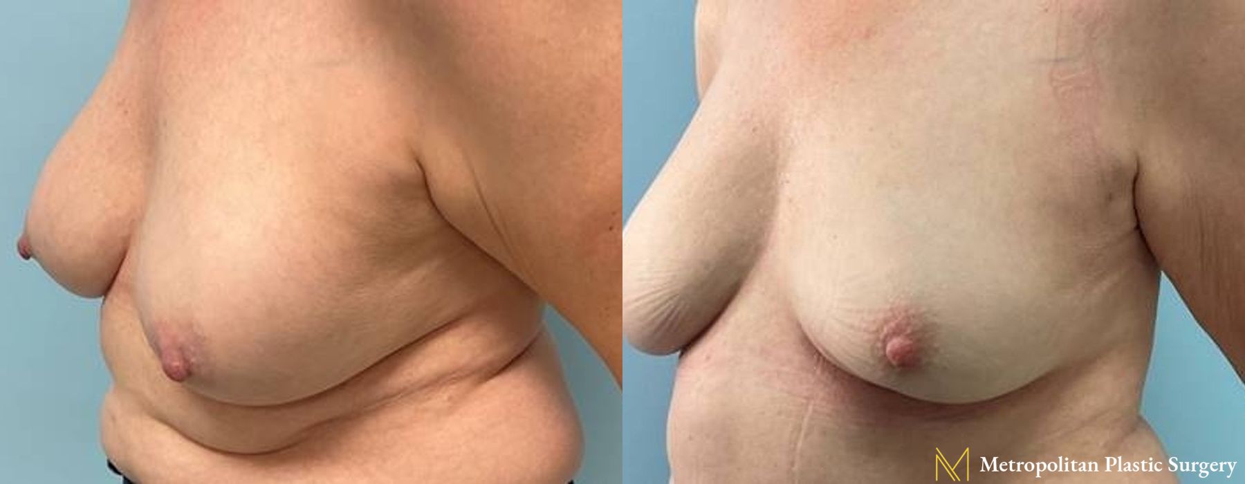 Before and after Fat Grafting case 8096 - Angle 2