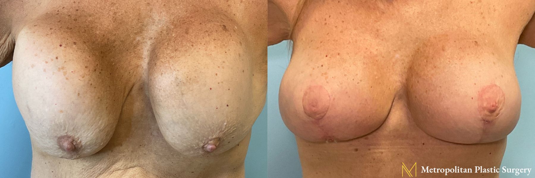 Before and after Breast Revision case 23903