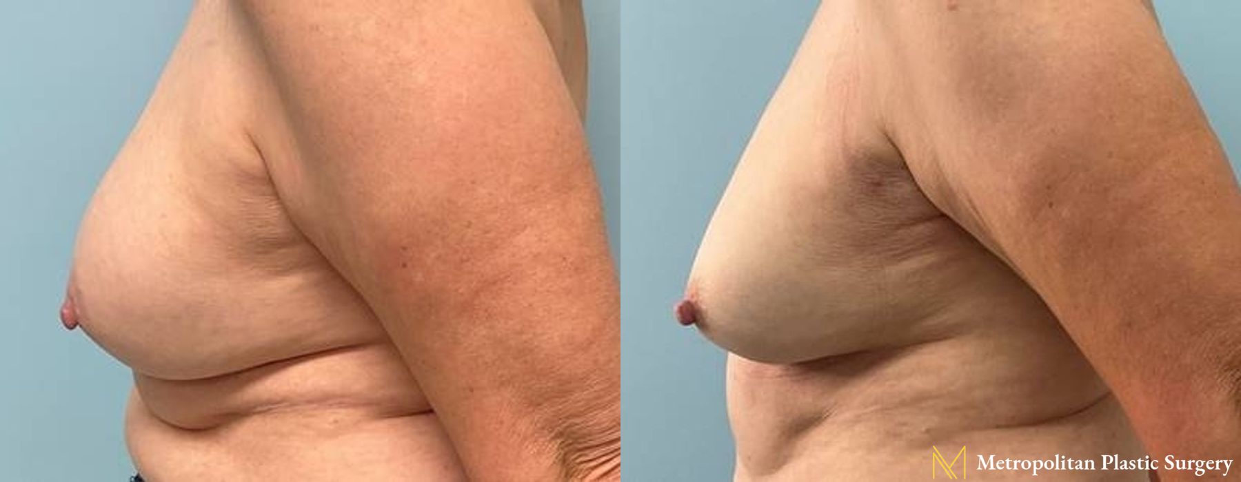 Before and after Fat Grafting case 8096 - Angle 3