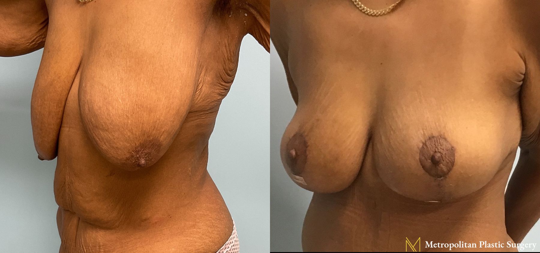 Before and after Mommy Makeover case 7998 - Angle 5