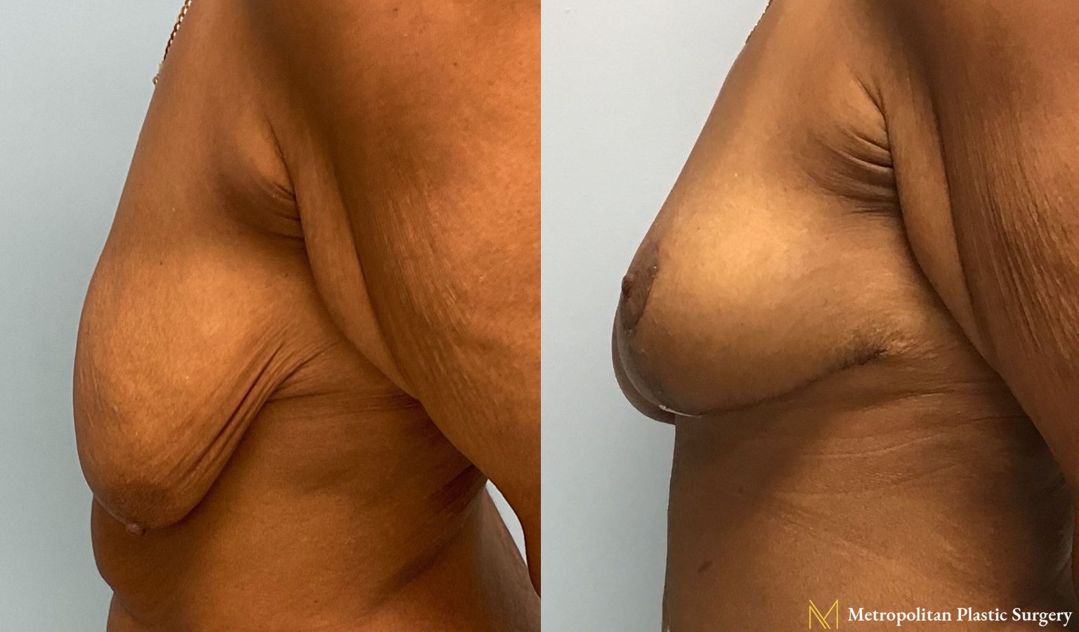 Before and after Mommy Makeover case 7998 - Angle 4