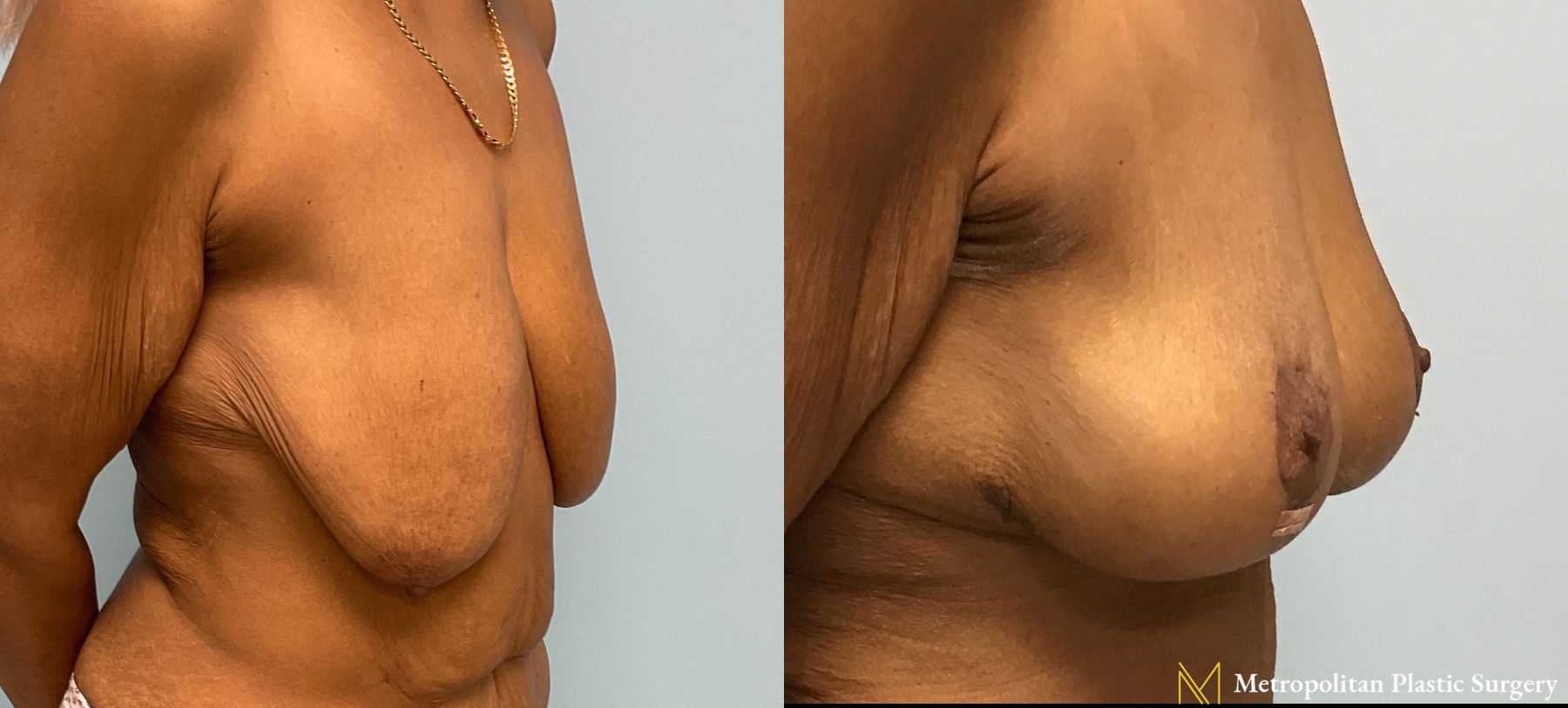 Before and after Mommy Makeover case 7998 - Angle 3