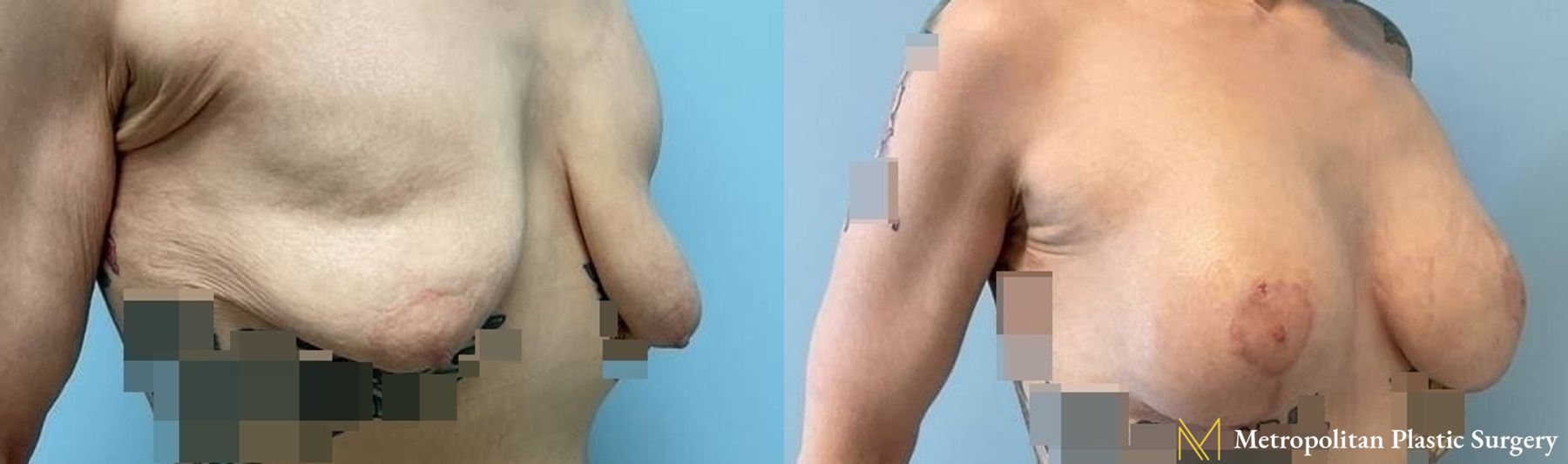 Before and after Fat Grafting case 8093 - Angle 2