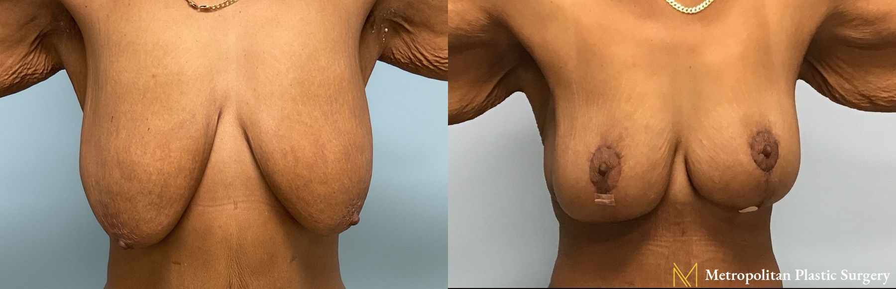 Before and after Mommy Makeover case 7998