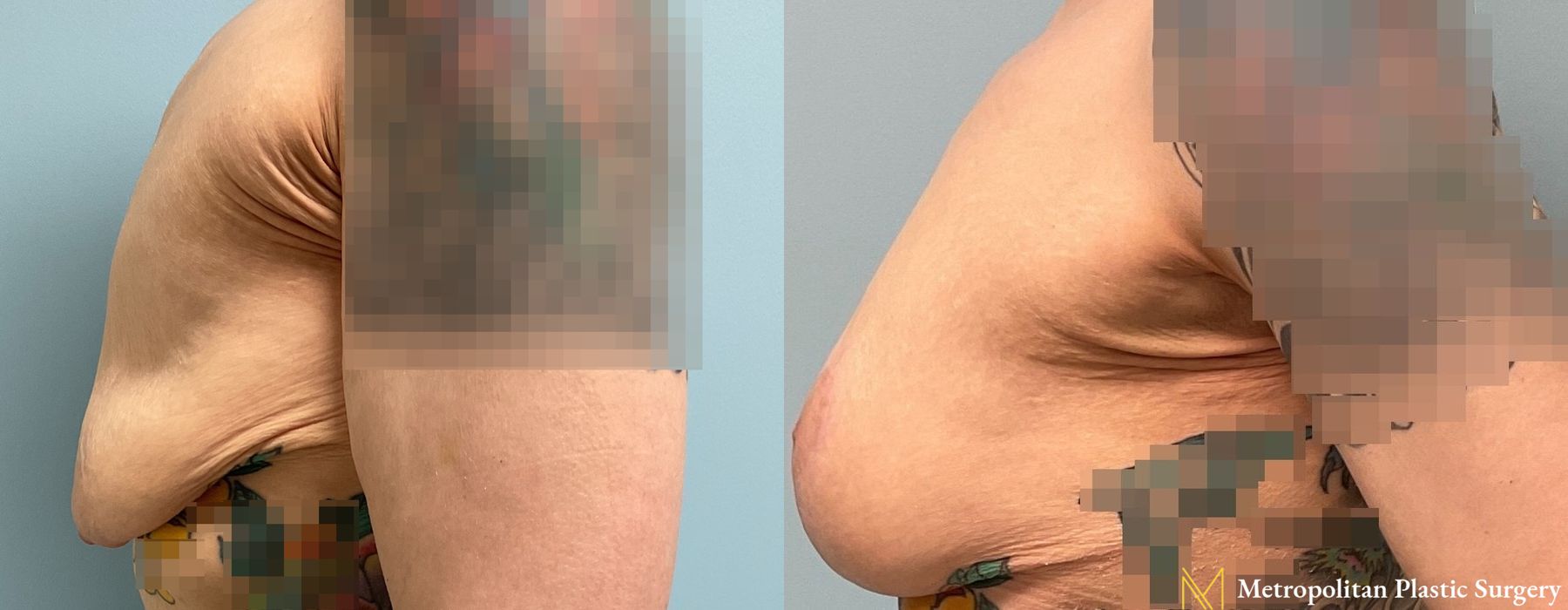 Breast Lift - Case 88