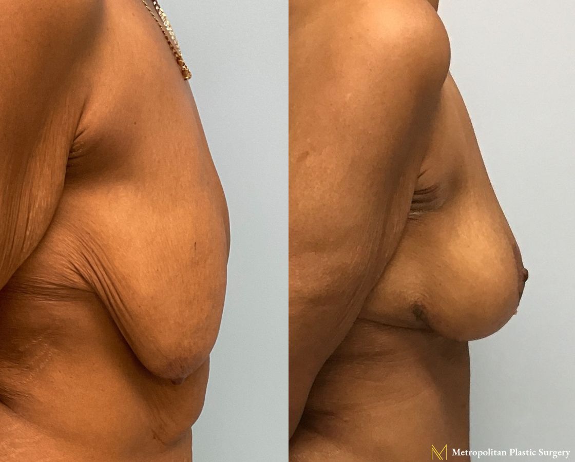 Before and after Mommy Makeover case 7998 - Angle 2
