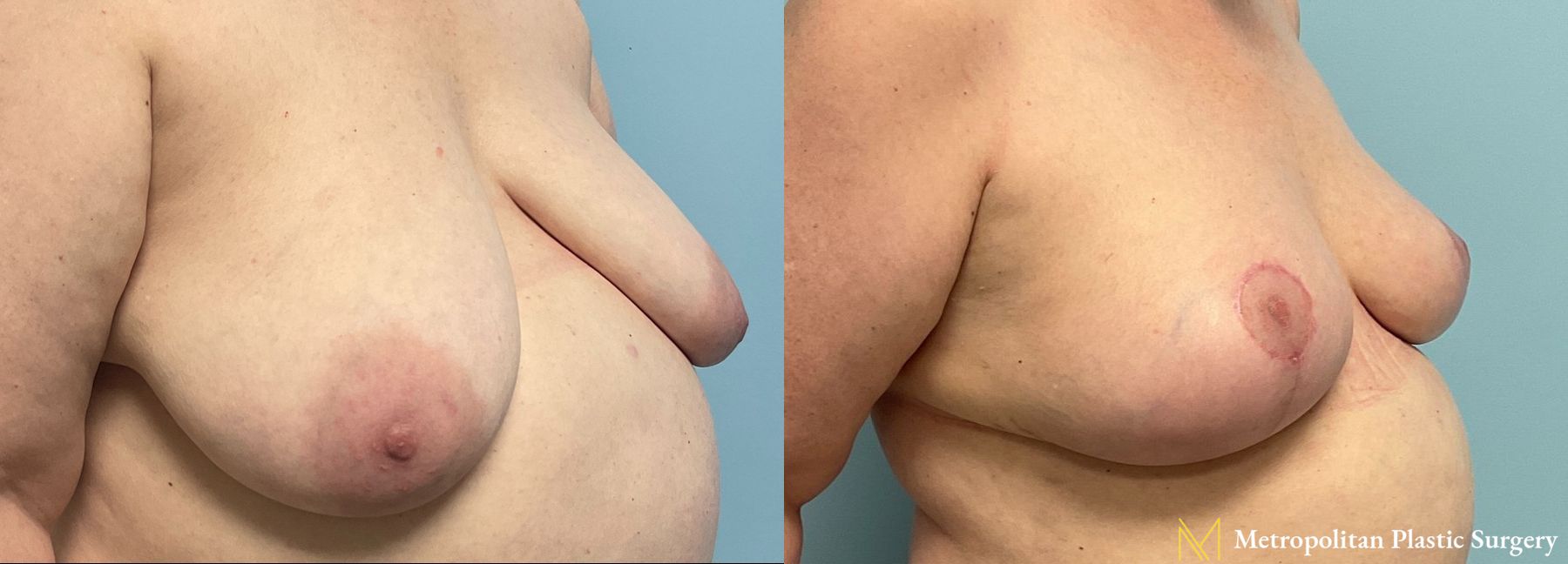Before and after breast lift surgery by Julia Spears MD - Angle 3
