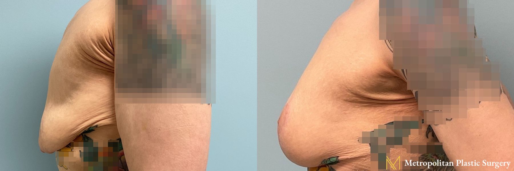 Before and after Fat Grafting case 8093 - Angle 3