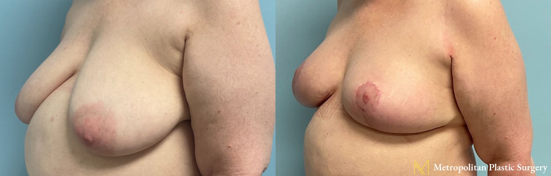 Before and after breast lift surgery by Julia Spears MD - Angle 5