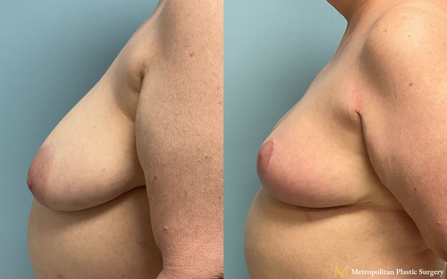 Before and after breast lift surgery by Julia Spears MD - Angle 4