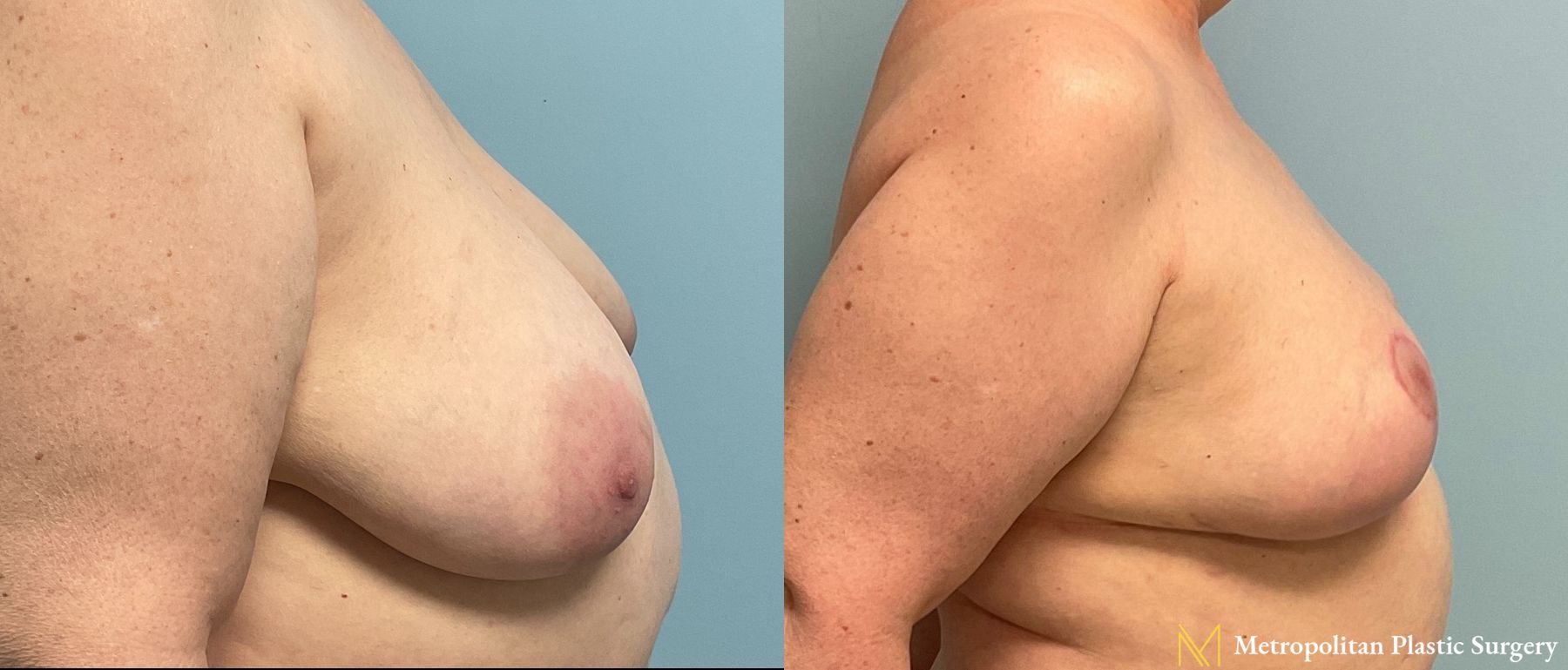 Before and after breast lift surgery by Julia Spears MD - Angle 2