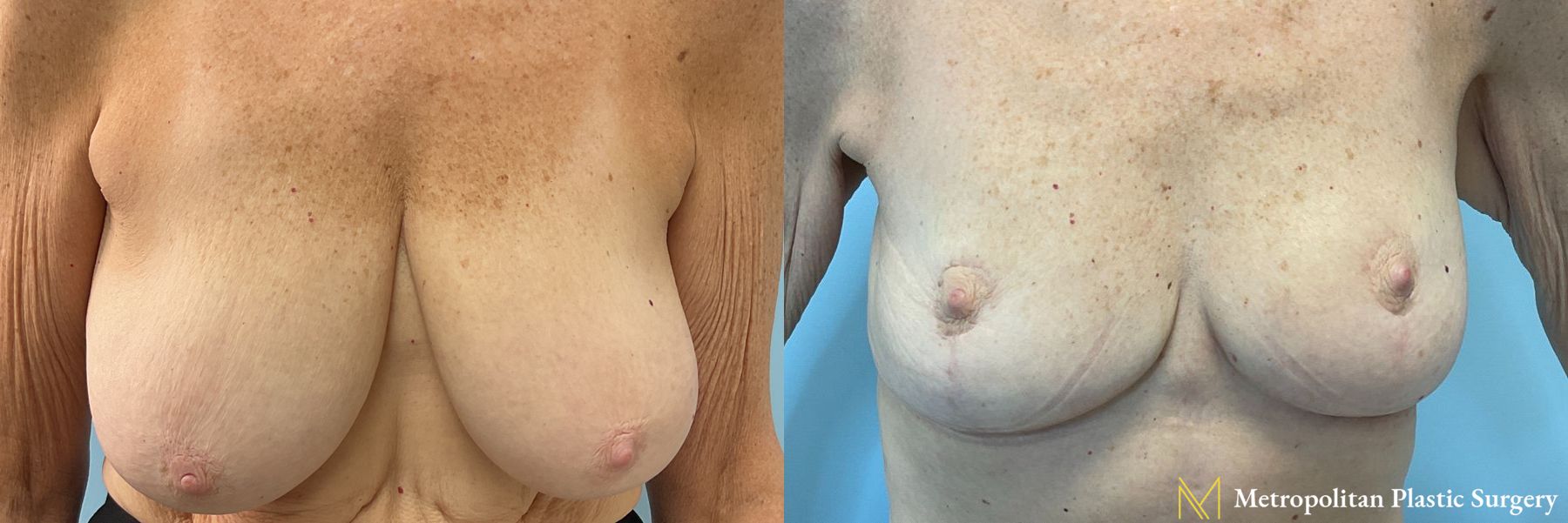 Breast Lift performed by Dr. Julia Spears