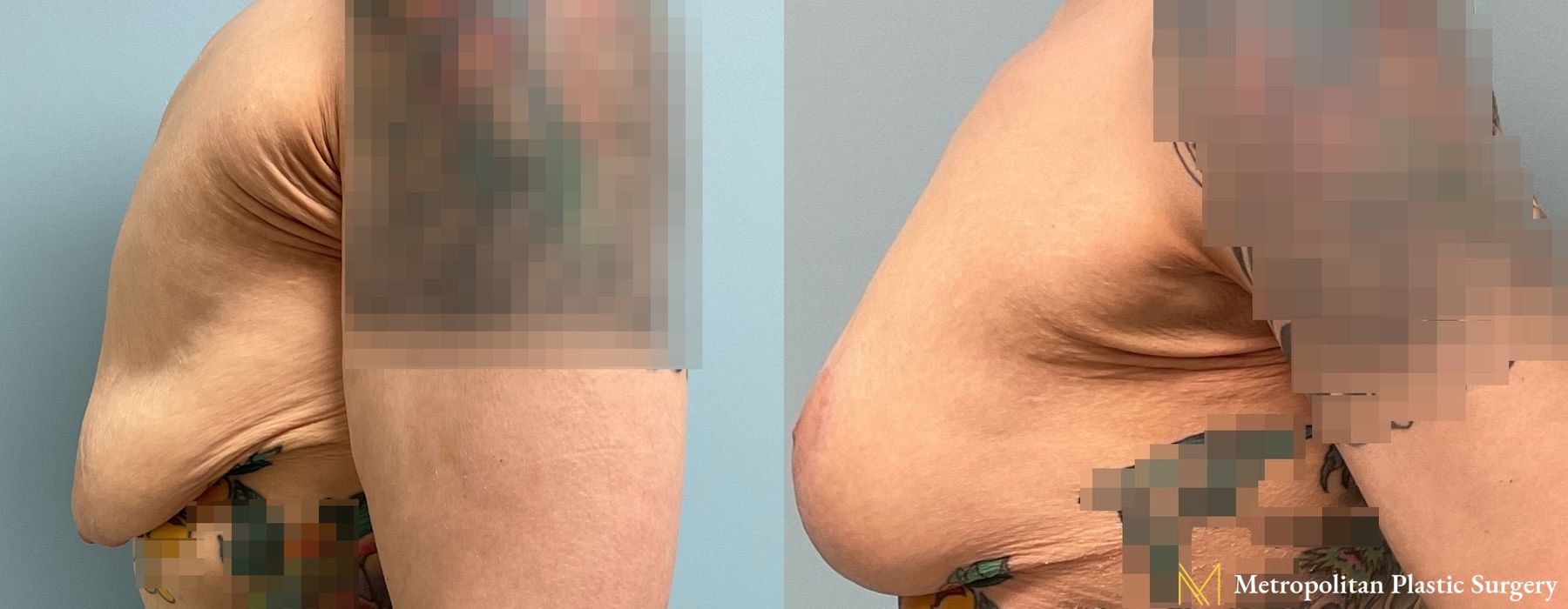 Before and after Fat Grafting case 8093 - Angle 3