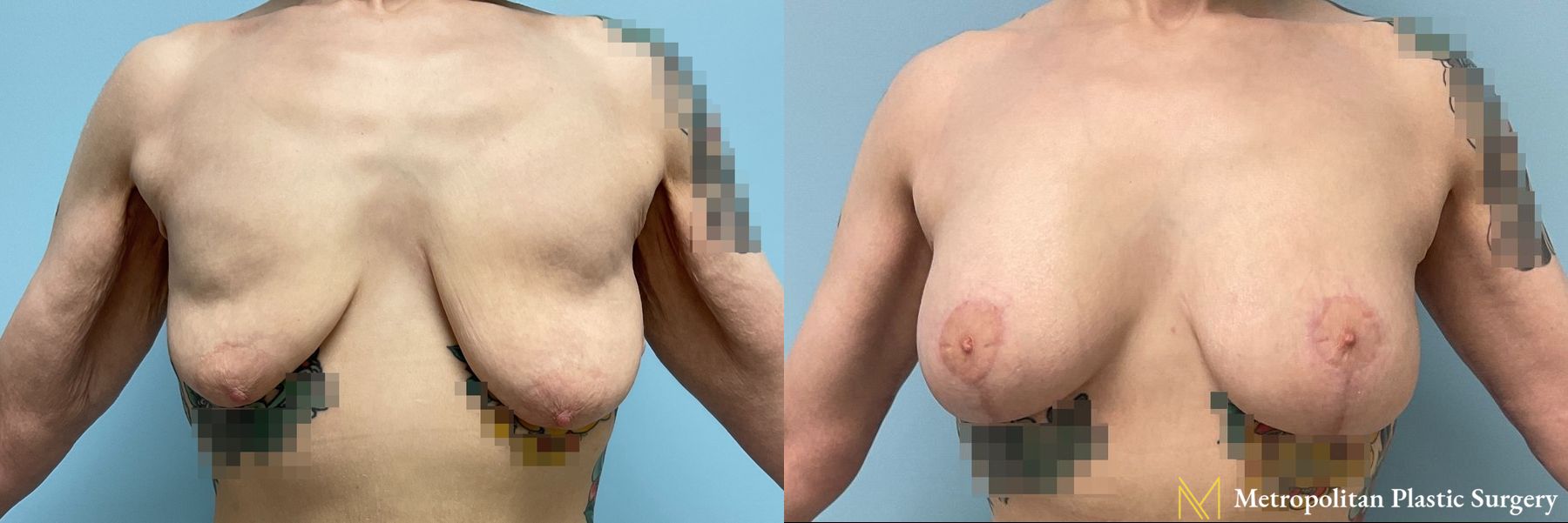 Before and after Fat Grafting case 8093