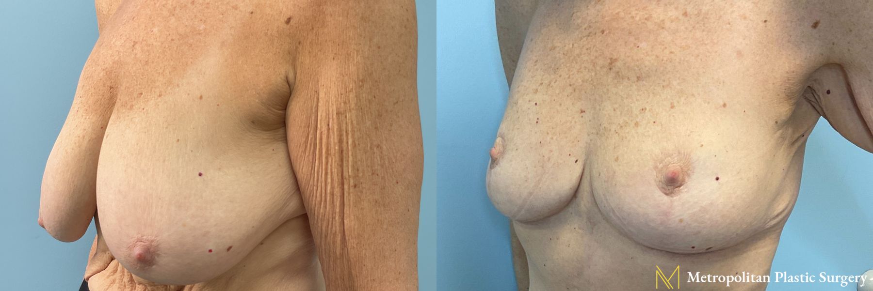 Breast Lift performed by Dr. Julia Spears - Angle 2