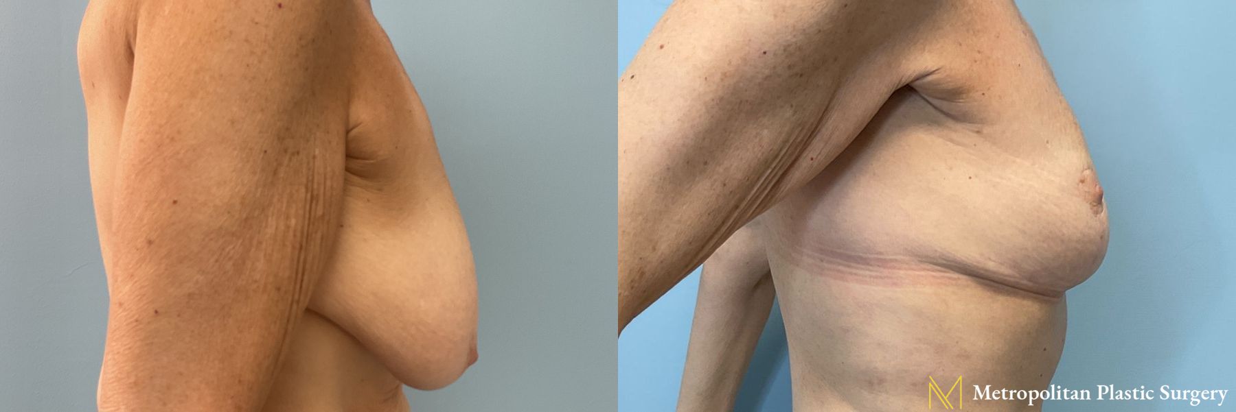 Breast Lift performed by Dr. Julia Spears - Angle 3